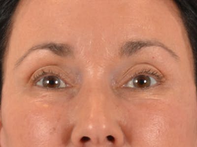 Eyelid Lift Before & After Gallery - Patient 113846 - Image 2