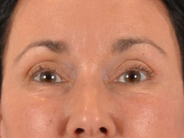 Eyelid Lift Before & After Gallery - Patient 113846 - Image 2