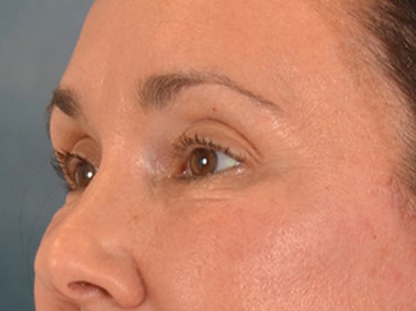 Eyelid Lift Before & After Gallery - Patient 113846 - Image 8