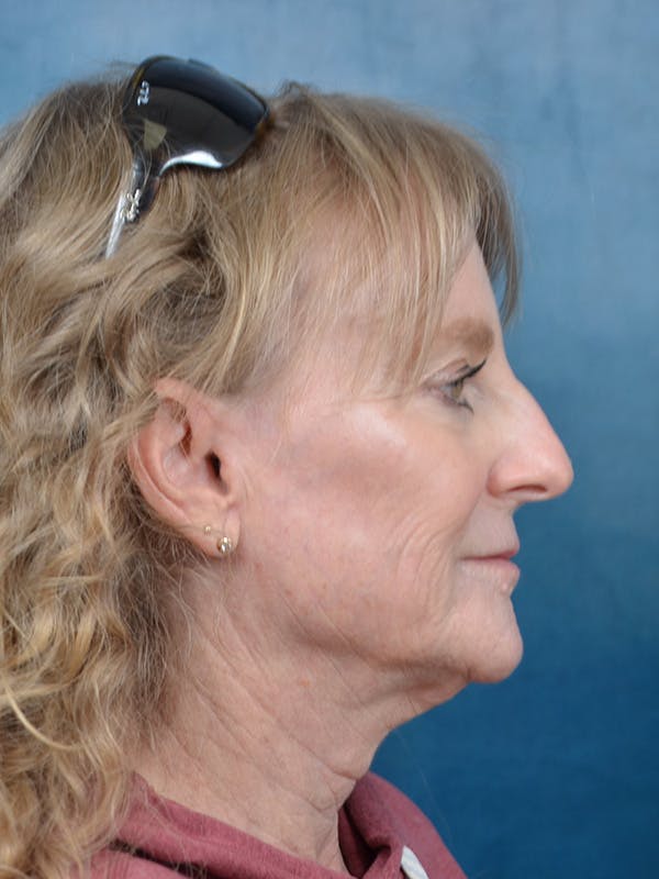 Brow Lift Before & After Gallery - Patient 261614 - Image 7