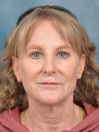 Laser Skin Resurfacing Before & After Gallery - Patient 307041 - Image 1