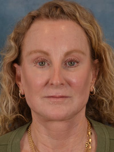 Laser Skin Resurfacing Before & After Gallery - Patient 307041 - Image 2
