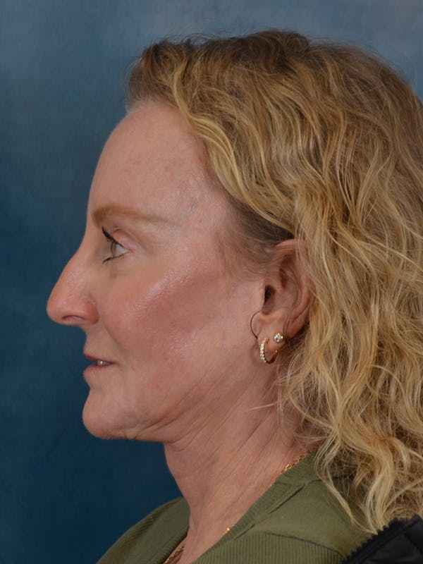 Brow Lift Before & After Gallery - Patient 261614 - Image 10