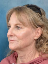 Deep Plane Facelift Before & After Gallery - Patient 208772 - Image 1