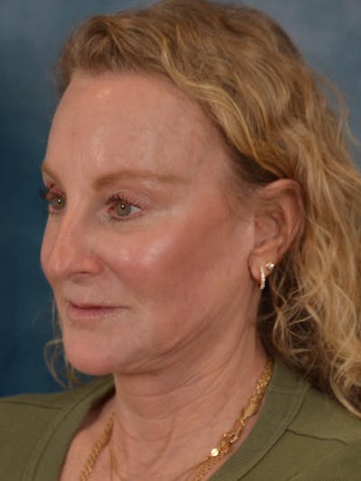 Brow Lift Before & After Gallery - Patient 261614 - Image 4