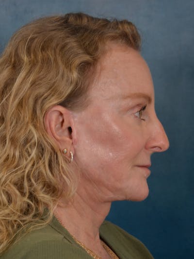 Brow Lift Before & After Gallery - Patient 261614 - Image 8