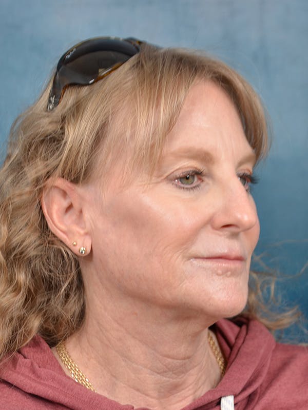 Brow Lift Before & After Gallery - Patient 261614 - Image 5