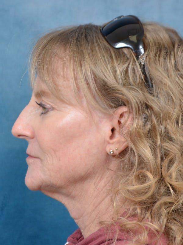 Brow Lift Before & After Gallery - Patient 261614 - Image 9