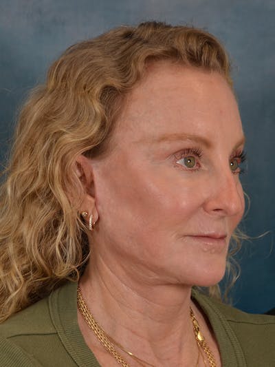 Brow Lift Before & After Gallery - Patient 261614 - Image 6