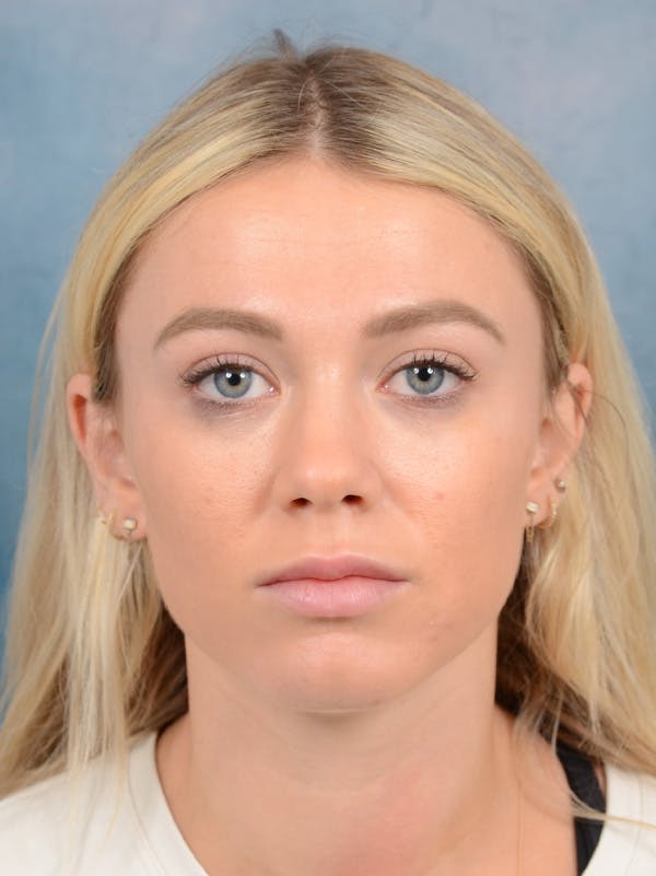 Rhinoplasty Before & After Gallery - Patient 262097 - Image 5