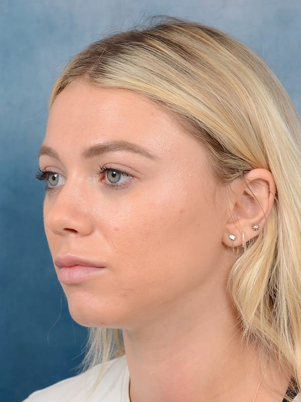 Rhinoplasty Before & After Gallery - Patient 262097 - Image 3