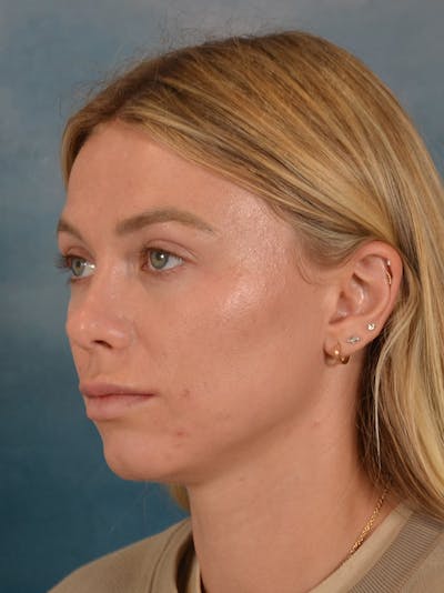 Rhinoplasty Before & After Gallery - Patient 262097 - Image 4