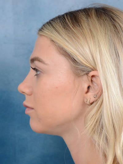 Rhinoplasty Before & After Gallery - Patient 262097 - Image 1