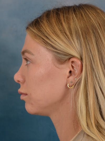 Rhinoplasty Before & After Gallery - Patient 262097 - Image 2