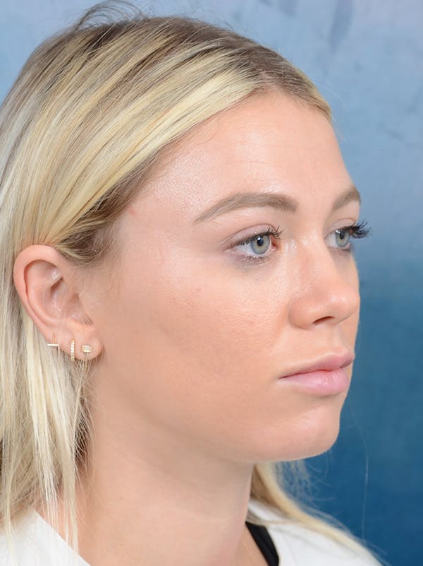 Rhinoplasty Before & After Gallery - Patient 262097 - Image 7