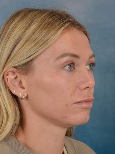 Rhinoplasty Before & After Gallery - Patient 262097 - Image 8