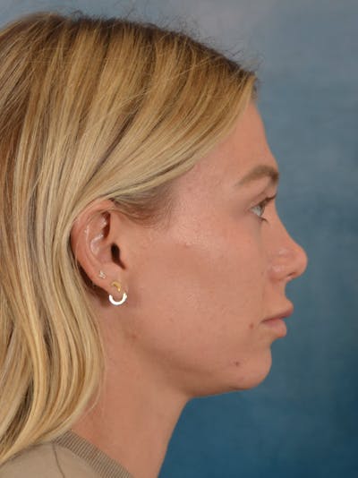 Rhinoplasty Before & After Gallery - Patient 262097 - Image 10