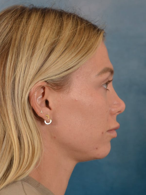 Rhinoplasty Before & After Gallery - Patient 262097 - Image 10