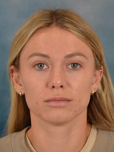 Rhinoplasty Before & After Gallery - Patient 262097 - Image 6