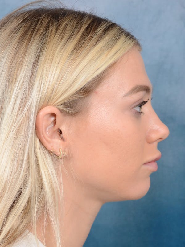 Rhinoplasty Before & After Gallery - Patient 262097 - Image 9