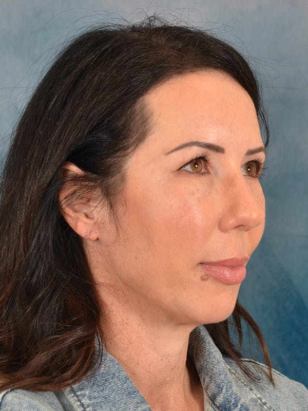 Brow Lift Before & After Gallery - Patient 366998 - Image 7