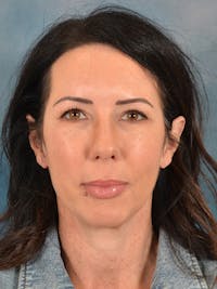 Brow Lift Before & After Gallery - Patient 366998 - Image 1