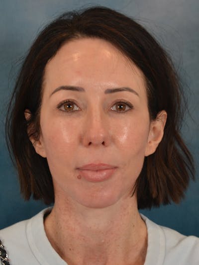 Brow Lift Before & After Gallery - Patient 366998 - Image 2