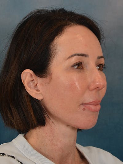 Brow Lift Before & After Gallery - Patient 366998 - Image 8