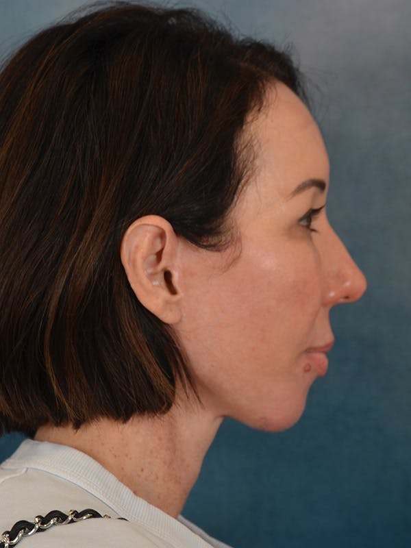 Brow Lift Before & After Gallery - Patient 366998 - Image 10