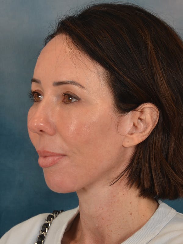 Brow Lift Before & After Gallery - Patient 366998 - Image 4