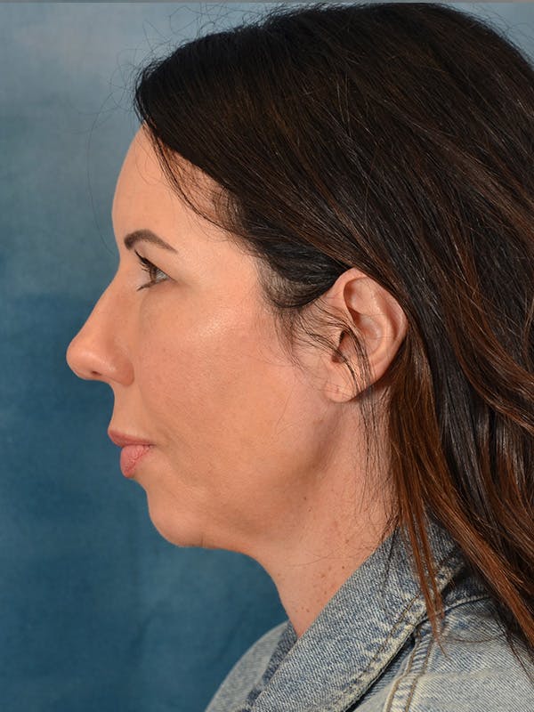 Brow Lift Before & After Gallery - Patient 366998 - Image 5