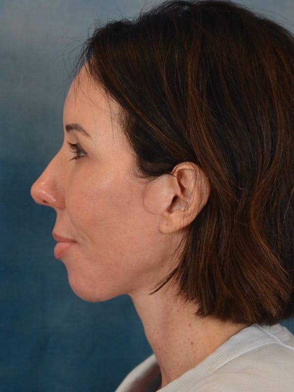 Brow Lift Before & After Gallery - Patient 366998 - Image 6