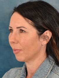 Deep Plane Facelift Before & After Gallery - Patient 416810 - Image 1