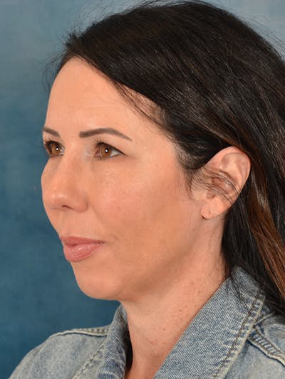 Deep Plane Facelift Before & After Gallery - Patient 416810 - Image 1