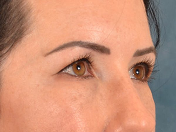 Eyelid Lift Before & After Gallery - Patient 327314 - Image 3