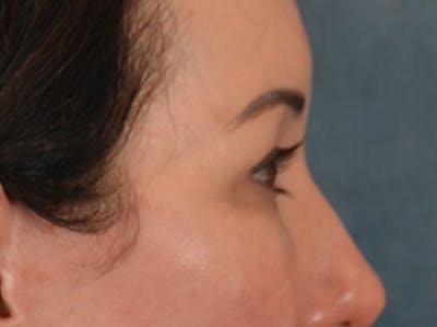 Eyelid Lift Before & After Gallery - Patient 327314 - Image 6