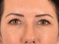 Eyelid Lift Before & After Gallery - Patient 327314 - Image 1
