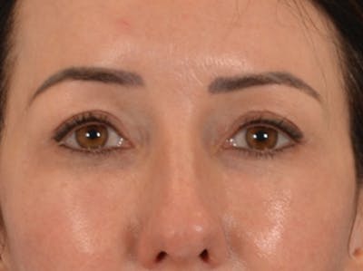 Eyelid Lift Before & After Gallery - Patient 327314 - Image 2