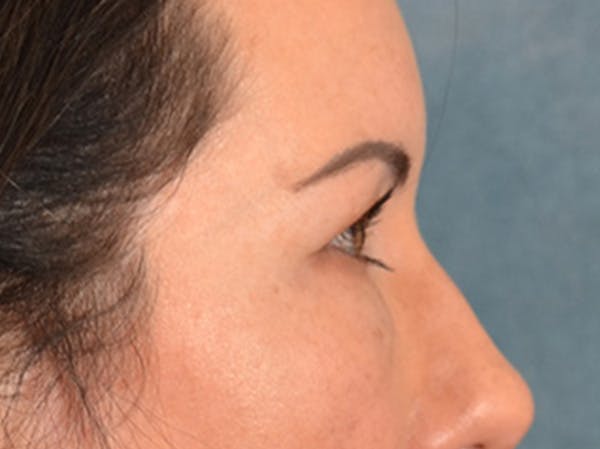 Eyelid Lift Before & After Gallery - Patient 327314 - Image 5