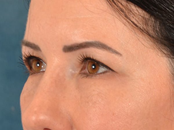 Eyelid Lift Before & After Gallery - Patient 327314 - Image 9