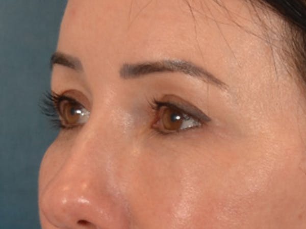 Eyelid Lift Before & After Gallery - Patient 327314 - Image 10