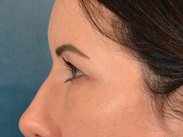 Eyelid Lift Before & After Gallery - Patient 327314 - Image 7