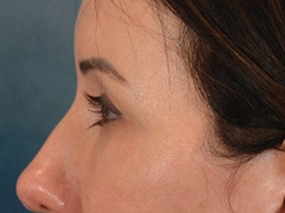 Eyelid Lift Before & After Gallery - Patient 327314 - Image 8