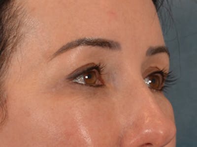 Eyelid Lift Before & After Gallery - Patient 327314 - Image 4