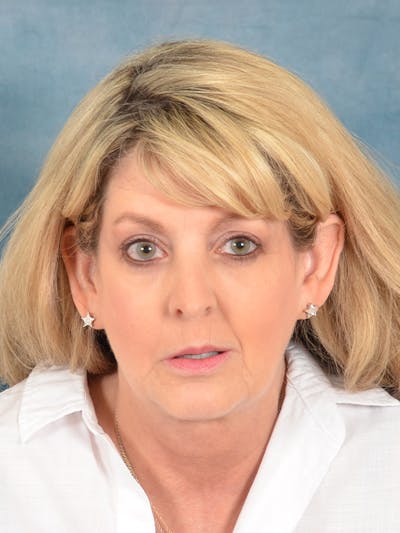 Laser Skin Resurfacing Before & After Gallery - Patient 292402 - Image 1