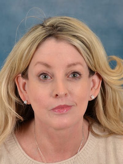 Laser Skin Resurfacing Before & After Gallery - Patient 292402 - Image 2