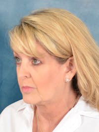Deep Plane Facelift Before & After Gallery - Patient 187878 - Image 1
