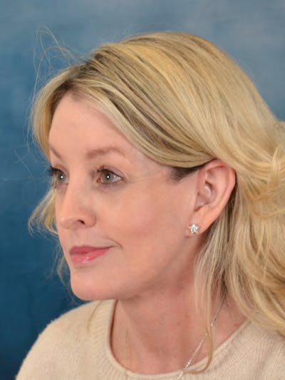 Brow Lift Before & After Gallery - Patient 217836 - Image 4
