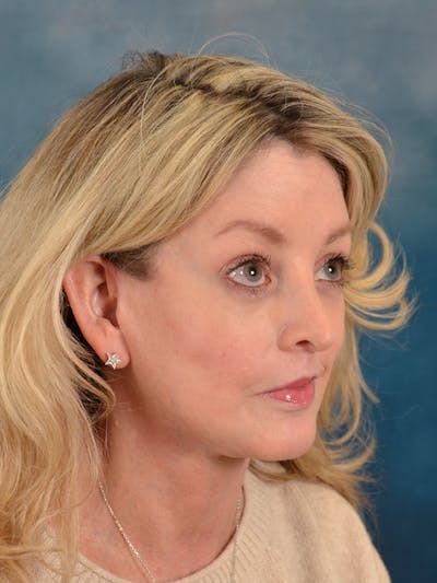 Brow Lift Before & After Gallery - Patient 217836 - Image 8