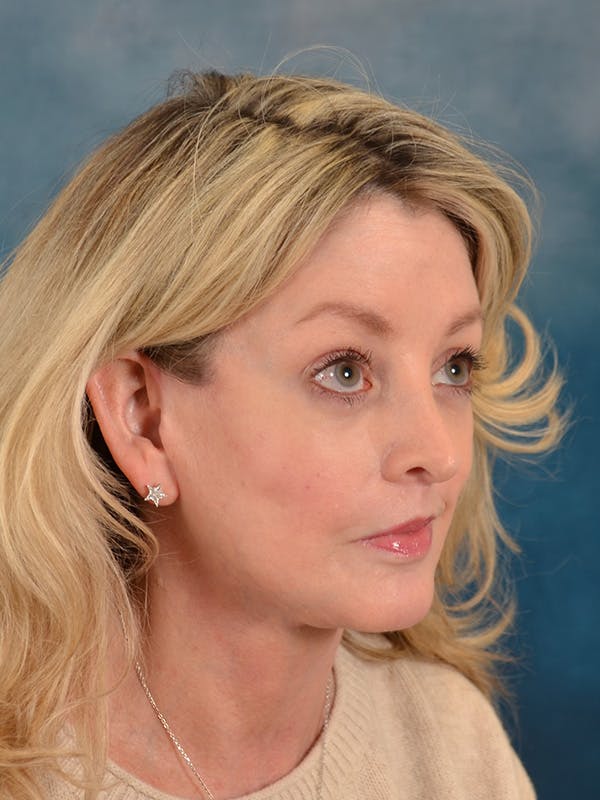 Brow Lift Before & After Gallery - Patient 217836 - Image 8